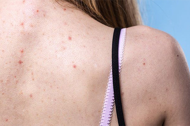 The Best Solutions To Treat Back Acne | Grazia India