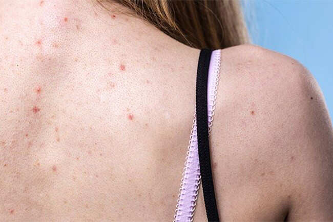 pinpoint red dots on skin worsens when running