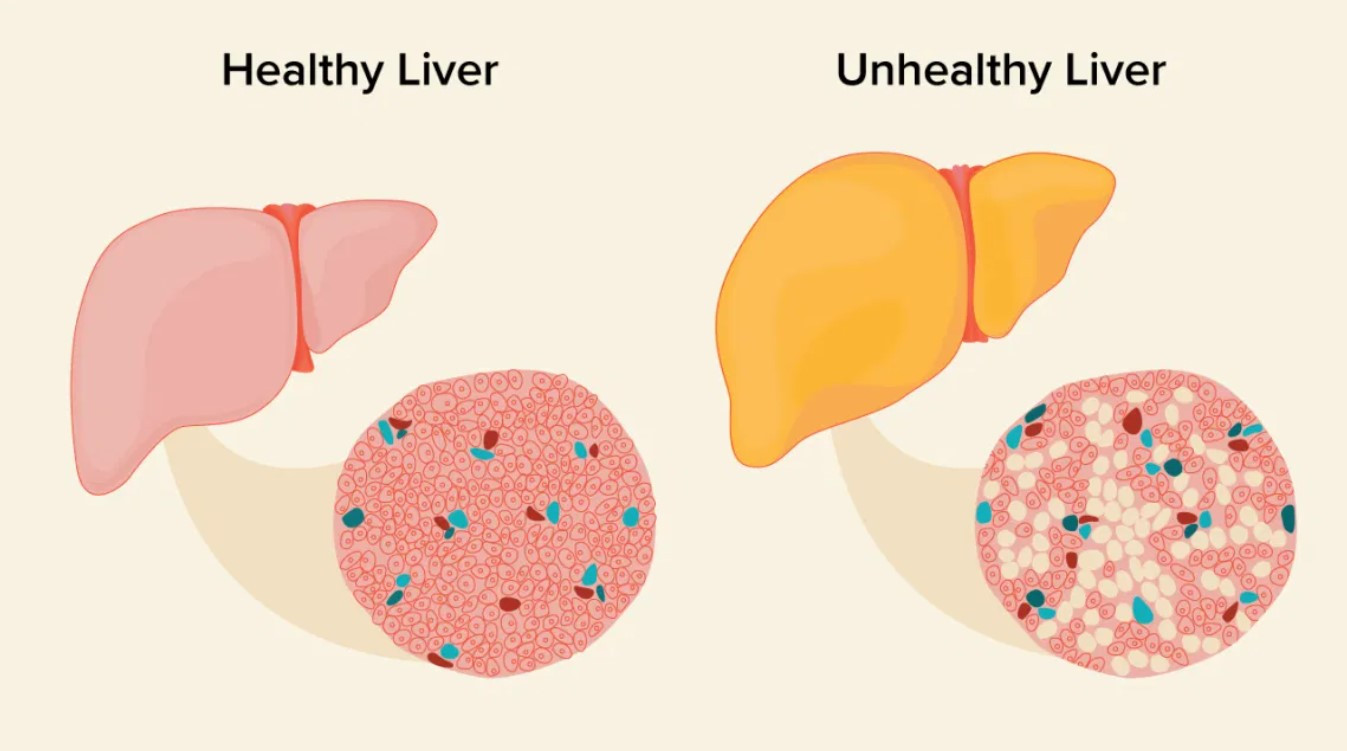 Healthy liver and a fatty liver.