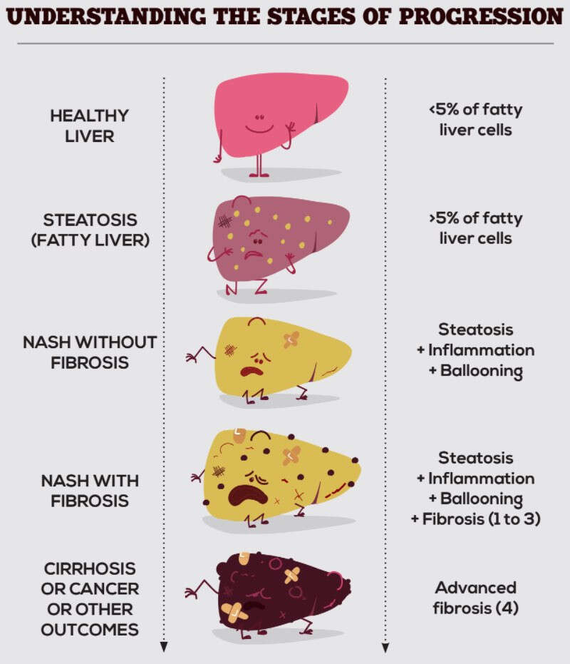 fatty-liver-disease-signs-to-watch-out-for